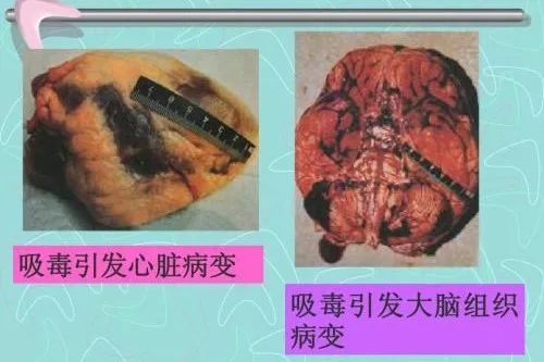 毒品对心血管系统产生直接毒性,吸毒经常引起各种心律失常和缺血性