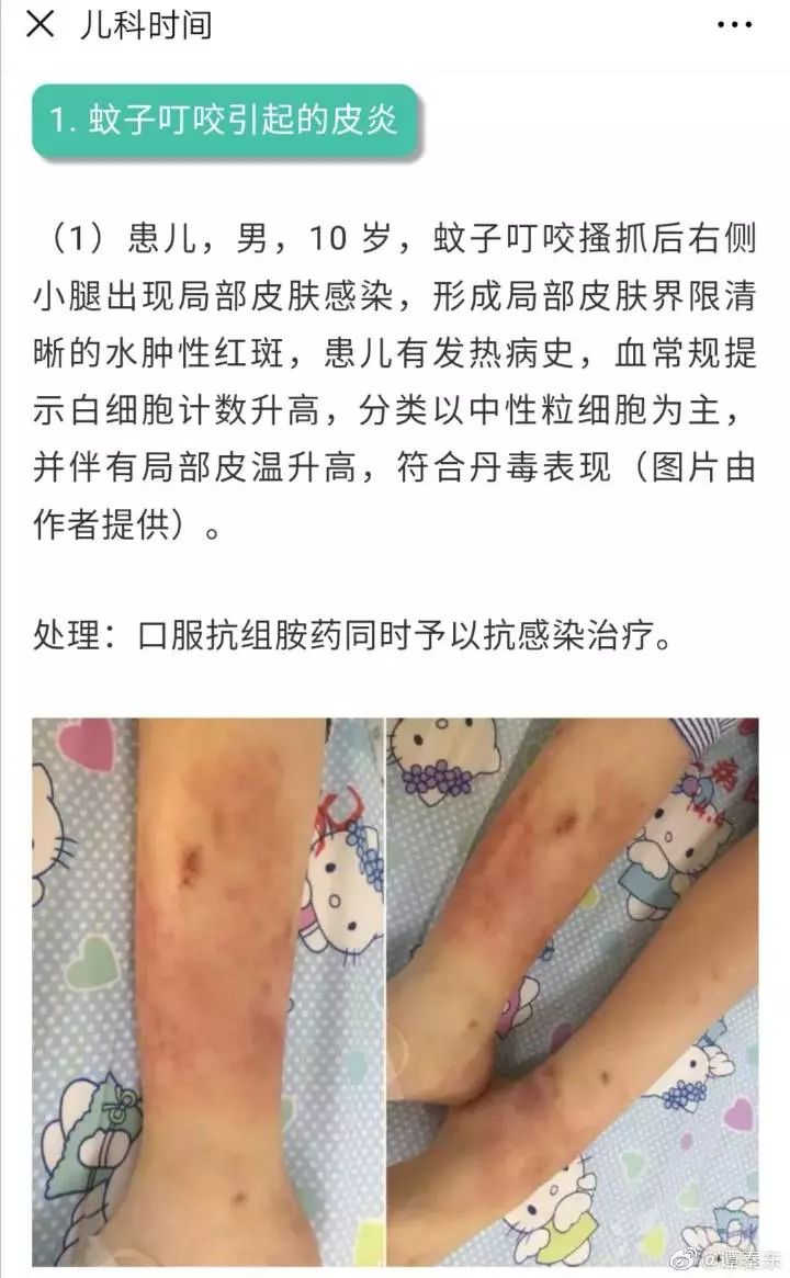 虫咬性皮炎治疗方法图片