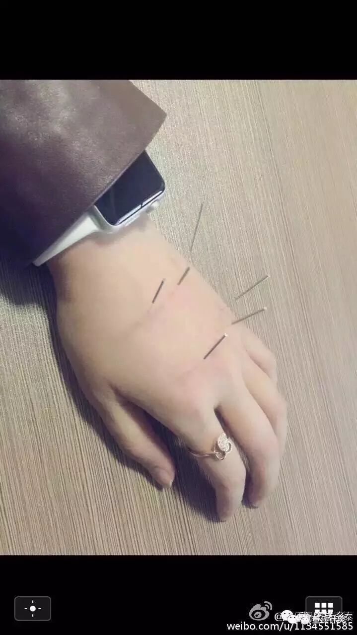 董氏针灸林正泰案例分享之手六白穴