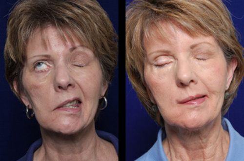 面肌痉挛常表现为一侧颜面部阵发性,不自主的肌肉痉挛,抽搐多从眼