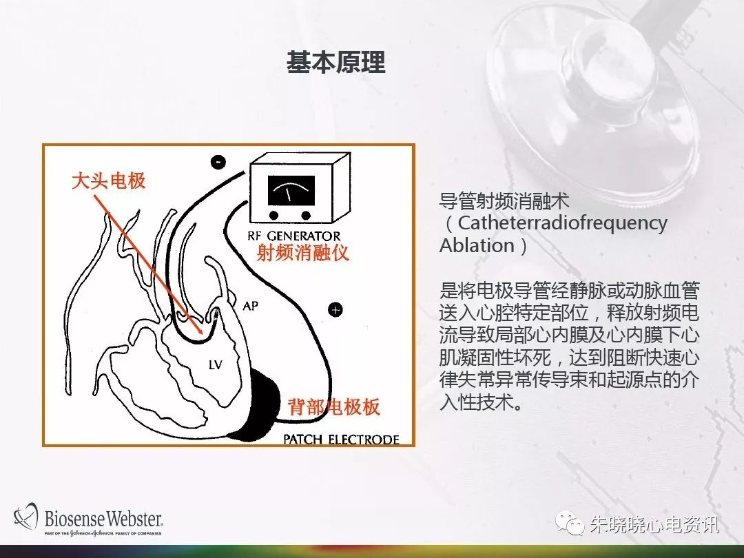 射频消融术介绍