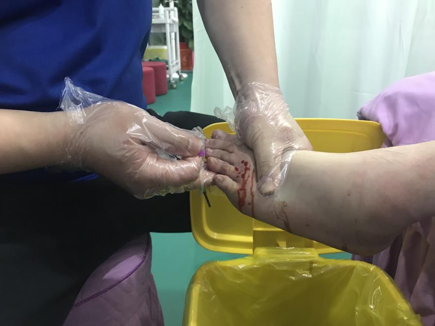 针刺放血:活血化瘀肌内效贴固定:限制内翻,固定骰趾关节无痛下功能