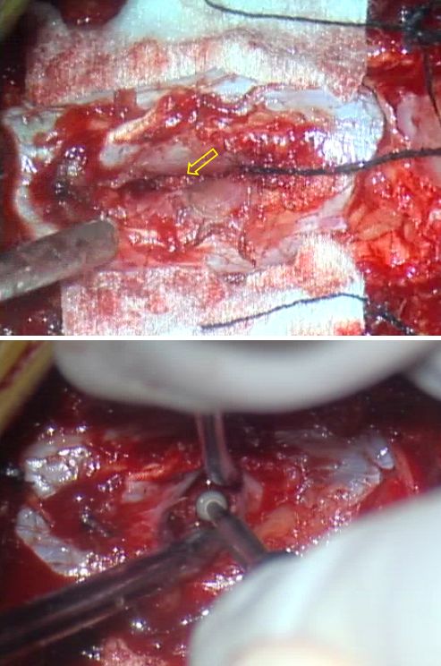 贝朗时间脊柱裂专题月尚爱加教授脊髓纵裂畸形手术经验分享