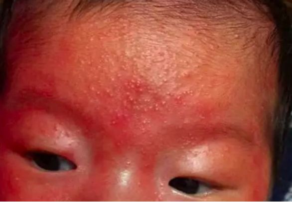 若出现红疹(皮疹尖端有水泡,四周发红),会略微感到皮肤发烫,刺痛,瘙痒