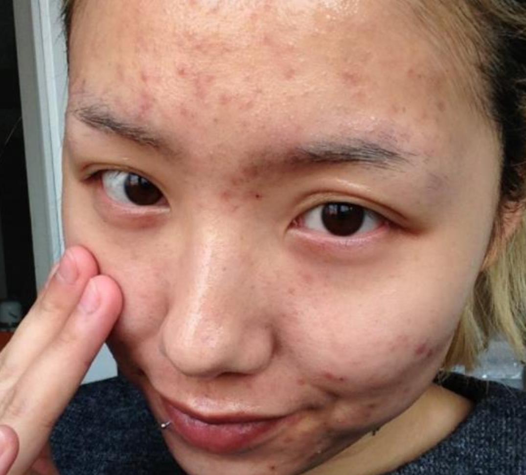 原创大学生青春痘困扰大学生长青春痘怎么办