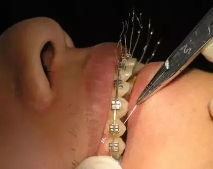 弓丝结扎及扎丝末端处理技巧