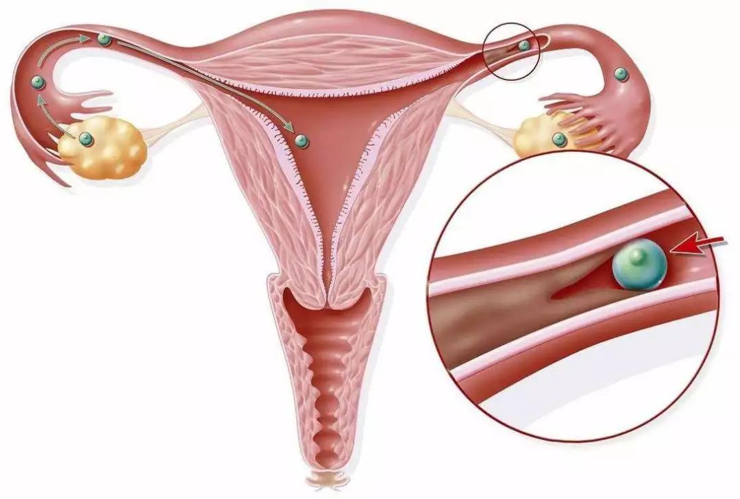 宫腔粘连内膜过薄看宫腔镜如何治疗不孕症