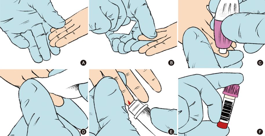 棉签擦去第一滴血(除非即时检测装置厂家说明书中要求检测第一滴血)