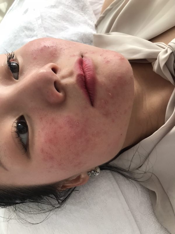 激素脸的症状您对此了解多少