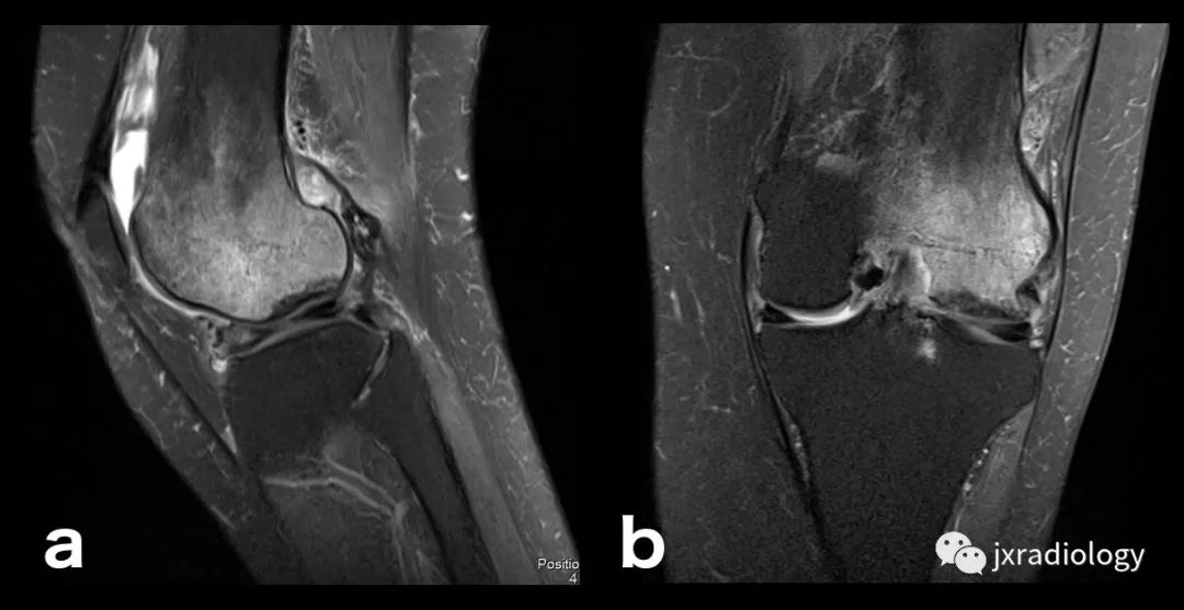 收藏膝关节骨髓水肿影像综述