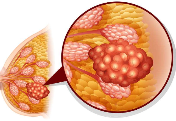 有时乳腺癌还会向着淋巴部位扩散,比如导致腋窝淋巴结出现异常肿大,这