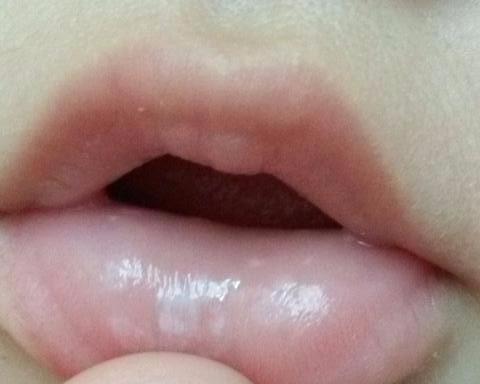 宝宝突然不愿吃奶,"厌奶",可能是这些原因_鹅口疮