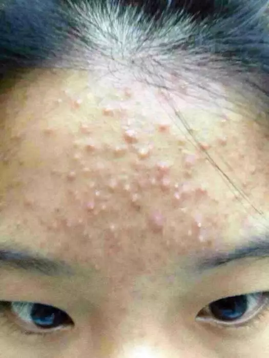 小慧护肤知识之开放性粉刺与闭合性粉刺有什么区别5个方法可以解决