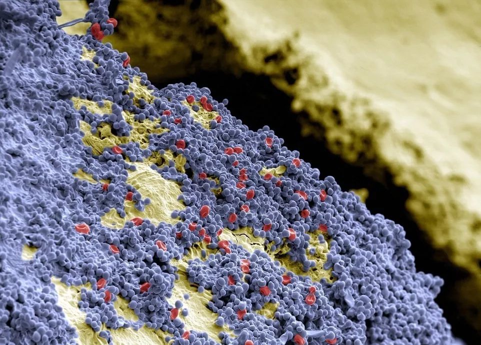 把牙斑再放大,会发现它上面紧紧地贴着一层蓝色地毯一样的球形细菌