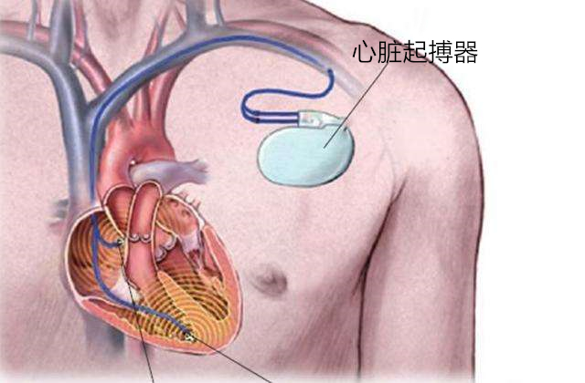 核动力心脏起搏器医疗史上的一次大胆尝试