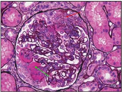 肾内病理图解 