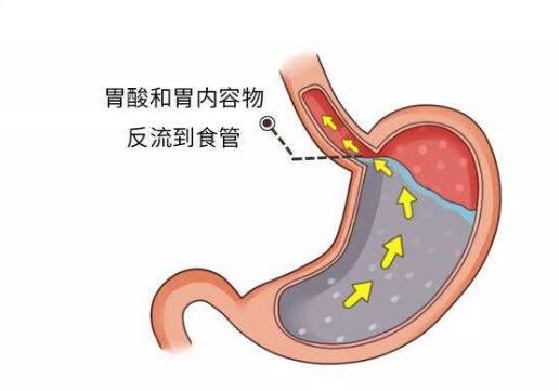 反流性食管炎常發生於哪些人群