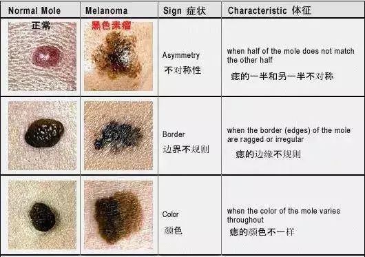 黑色素瘤会长毛吗图片