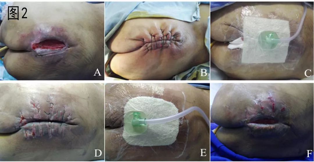 圖g-n骶尾部圓盤狀壓瘡行牽張負壓v形癒合法治療示意圖