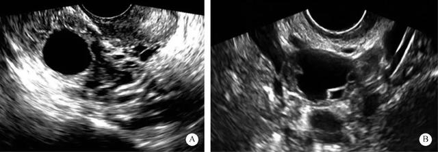 图5-1-5 卵泡形态超声声像图