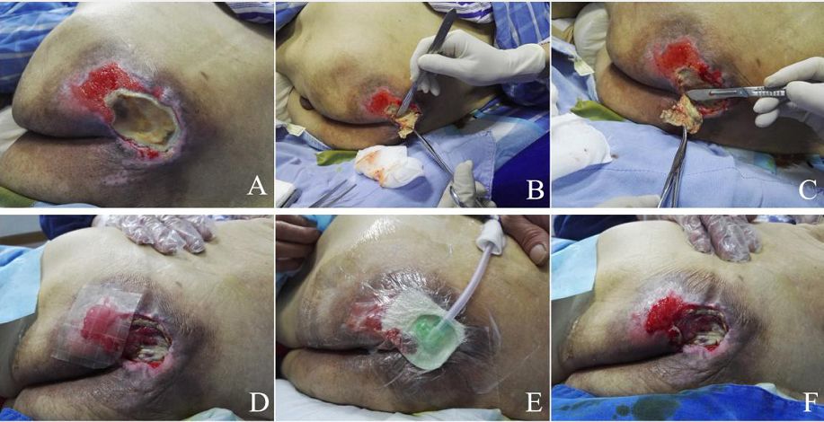 部圓盤狀壓瘡,用手術刀切除表層的壞死組織,肉芽創面上貼敷水膠體敷料