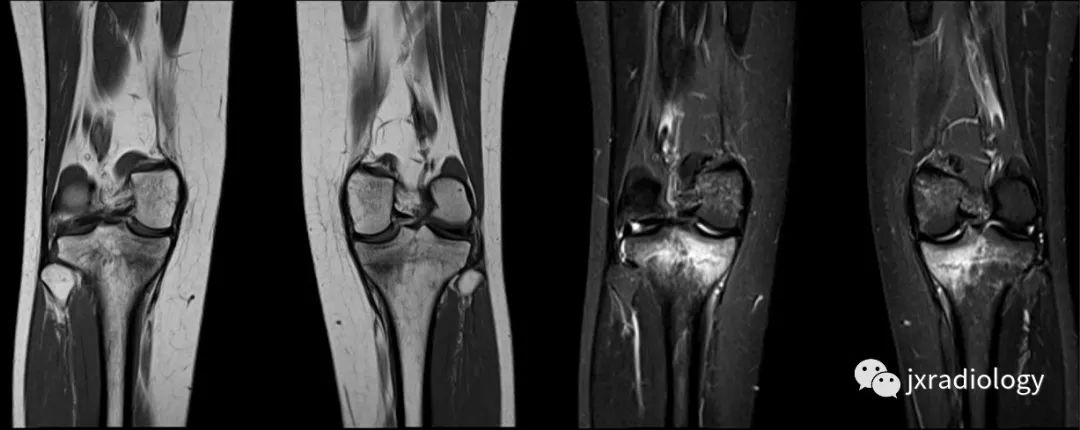 收藏膝关节骨髓水肿影像综述