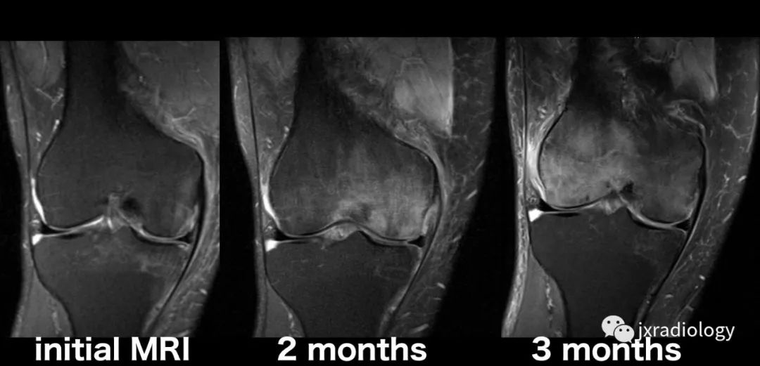收藏膝关节骨髓水肿影像综述