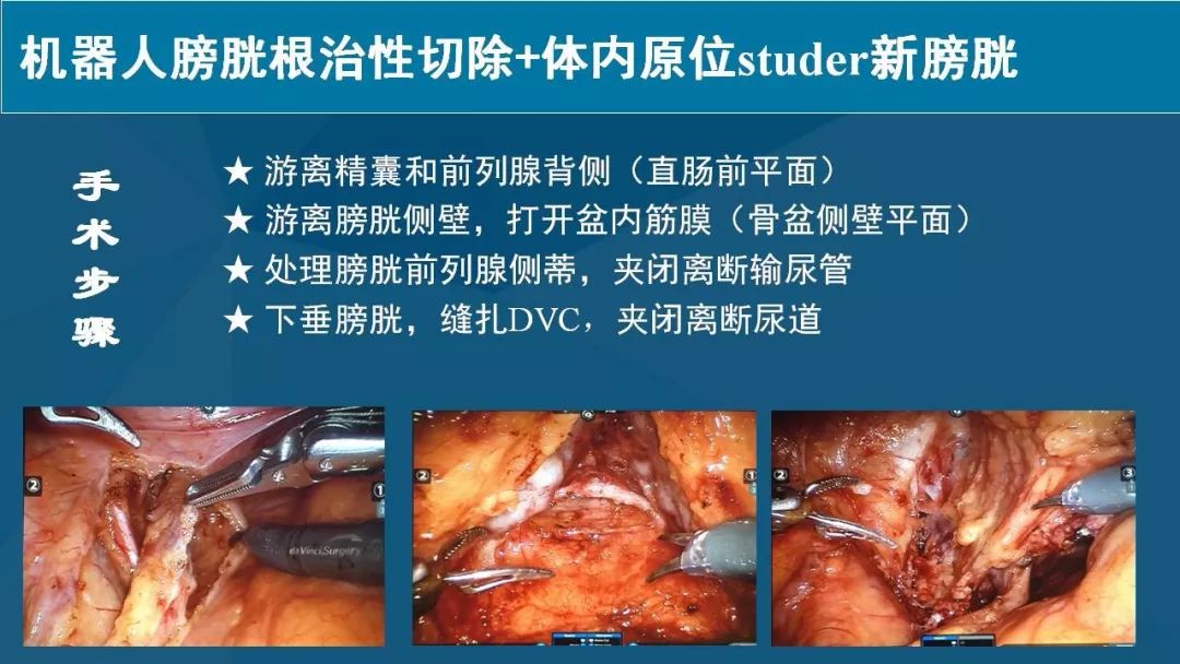 優秀論文推薦機器人全腔內studer原位新膀胱術手術經驗總結及臨床療效