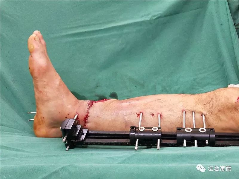 张家界男子小腿被绞对断,医院7小时力挽狂澜再植成活_断肢