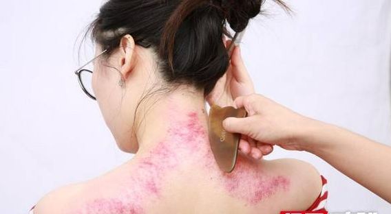 2,背部刮痧背部刮痧可调节肌肉的收缩和舒张,使组织间压力得到调节,以