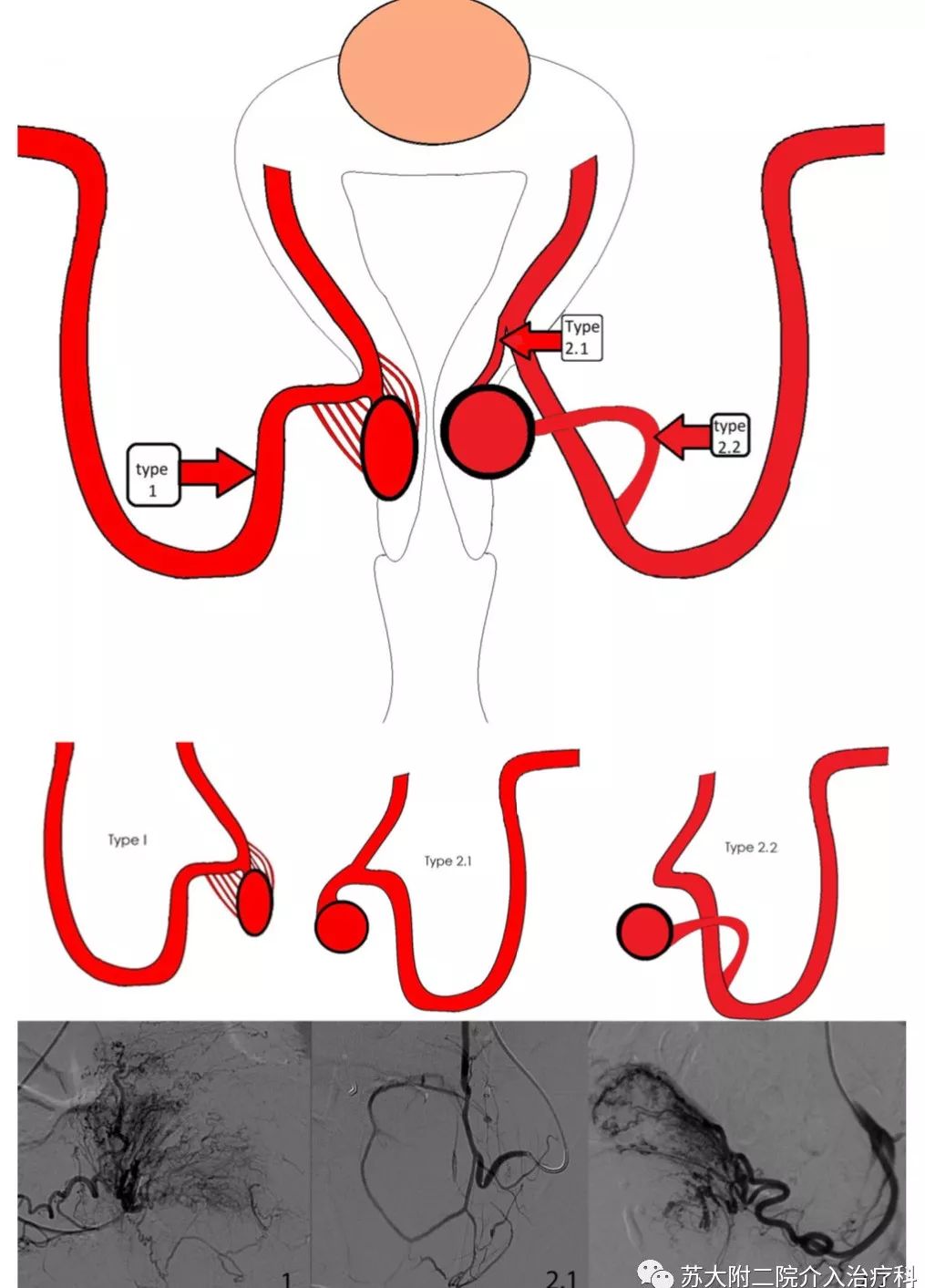 文献速递第136期子宫动脉栓塞治疗症状性宫颈肌瘤有效性和安全性