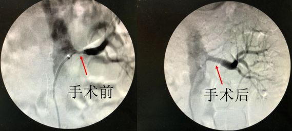 而当出现锁骨下动脉狭窄闭塞后,心脏的部分血供无法直接经病变的锁骨