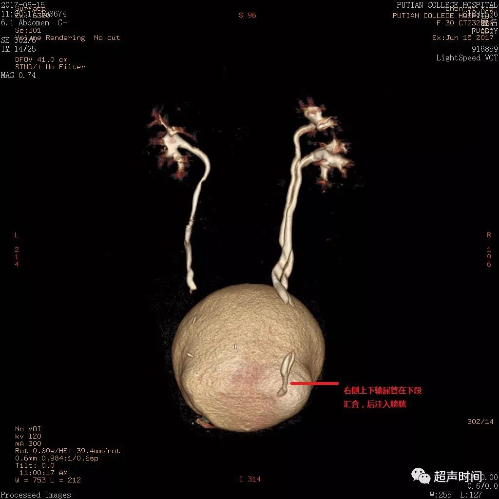 超声典型病例肾盂输尿管重复畸形