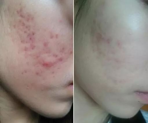 姨妈痘熬夜痘统统不用怕用它就对了