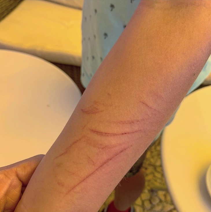 5岁阿弟遭同学树枝狂打超狂反击7万人赞爆