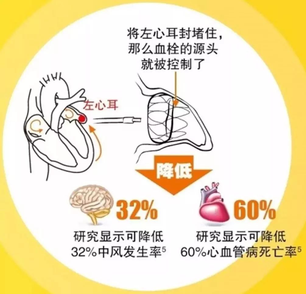 左心耳封堵适应症图片