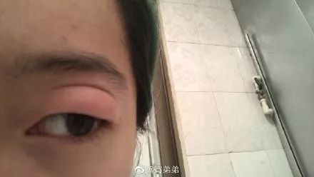 今年这届蚊子真优秀有人被叮成大小眼有人被叮出了腮红