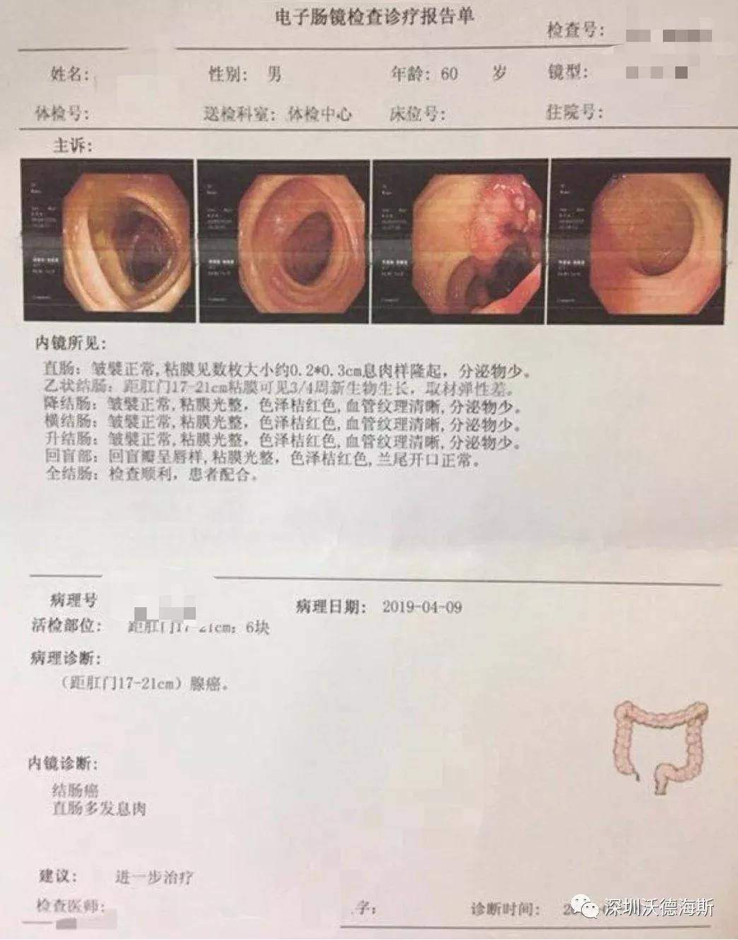 肠道健康有隐患,定量便隐血和肠镜一个都不能少!