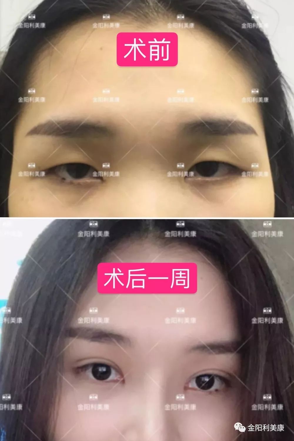 为什么6mm7mm的双眼皮数据没有绝对意义