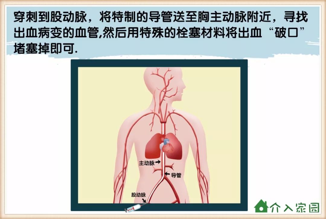 漫画科普│当咯血君遇到介入会发生什么