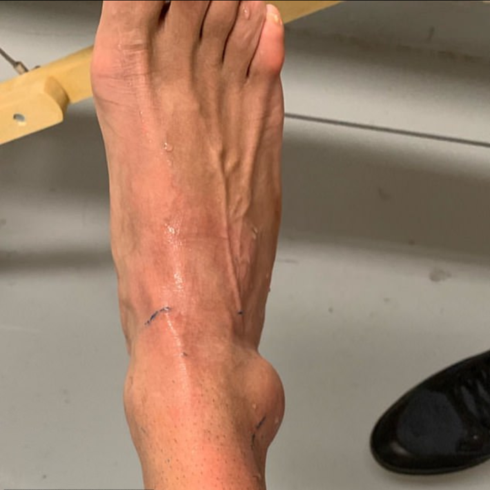 心疼内马尔晒受伤照片整个脚踝都肿了