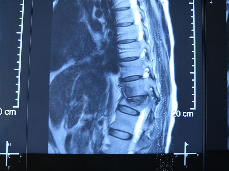 创伤外科成功开展胸椎结核手术