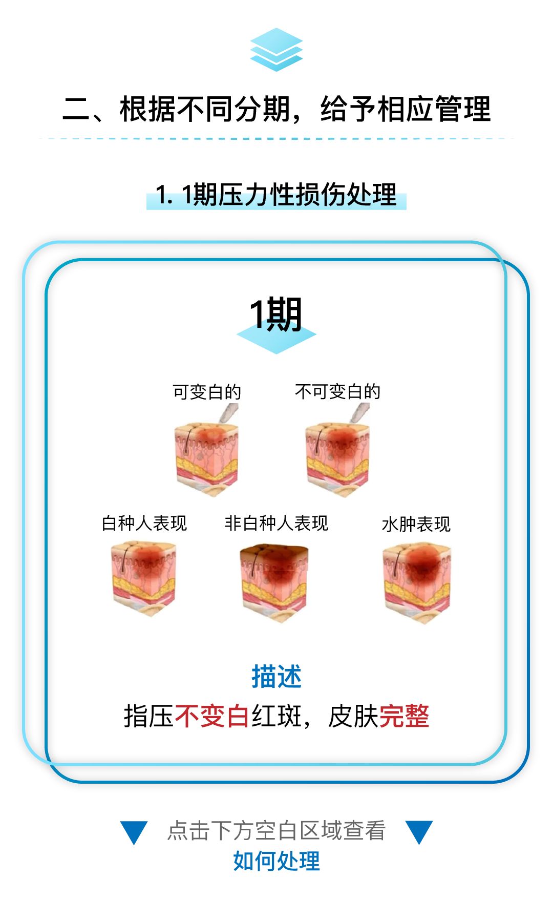 不同压力性损伤处理方案