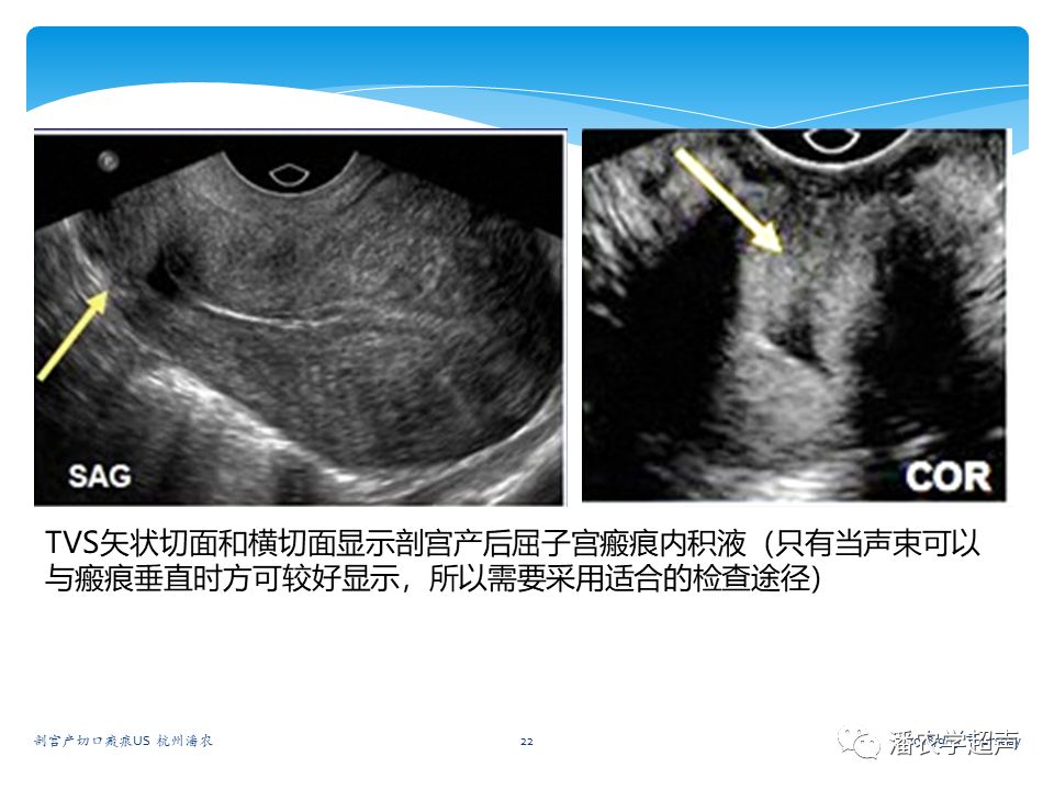 瘢痕子宫超声图片