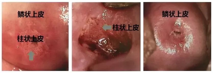 揭开宫颈糜烂囊肿肥大的真面目请避开这些过度医疗的重灾区