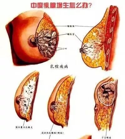 乳腺增生的几种不同表现