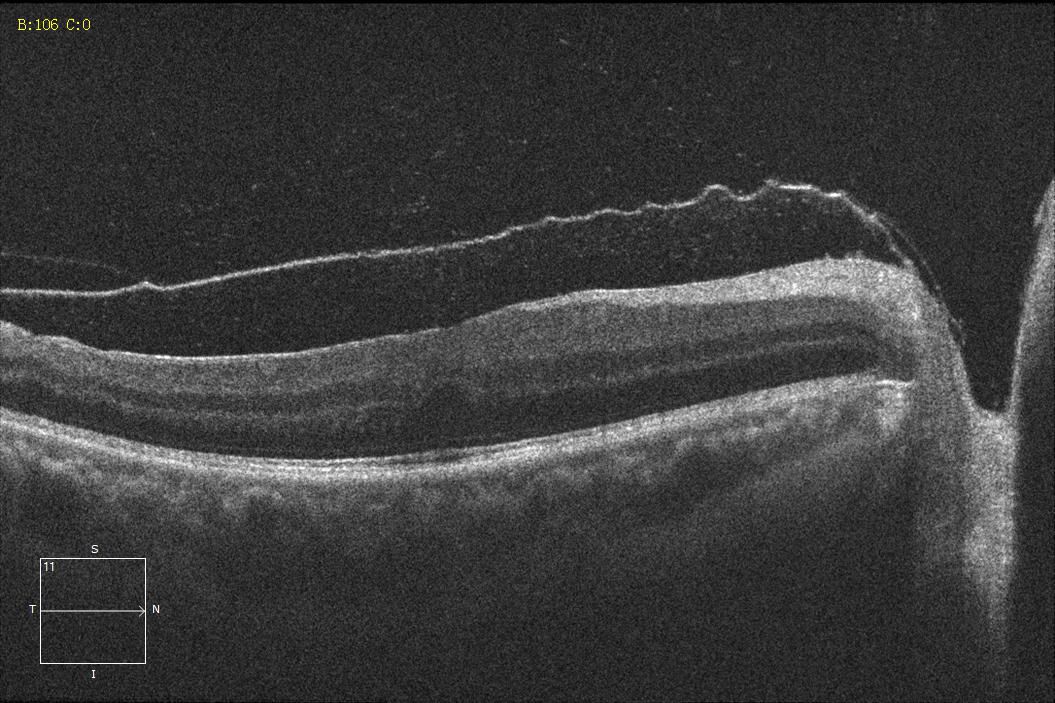 yag激光术后即刻行oct检查,可见右眼视网膜前出血转至玻璃体后界膜前