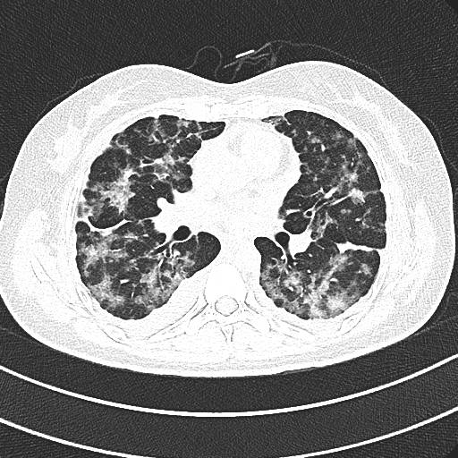 影像思维双肺弥漫性病变肺炎间质病肿瘤枯树枝小叶间隔