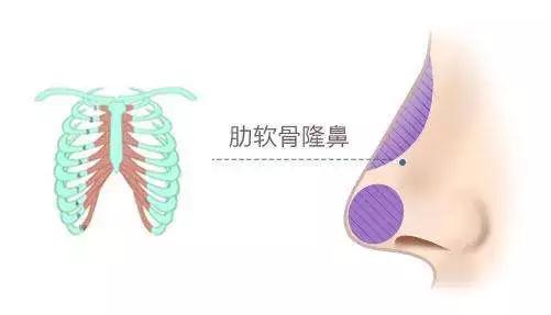 魏紅軍:肋軟骨隆鼻對身體有影響嗎?