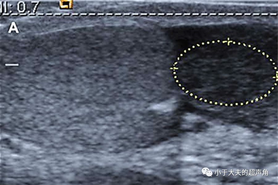 读书笔记横纹肌肉瘤小儿最常见的睾丸附属区恶性肿瘤